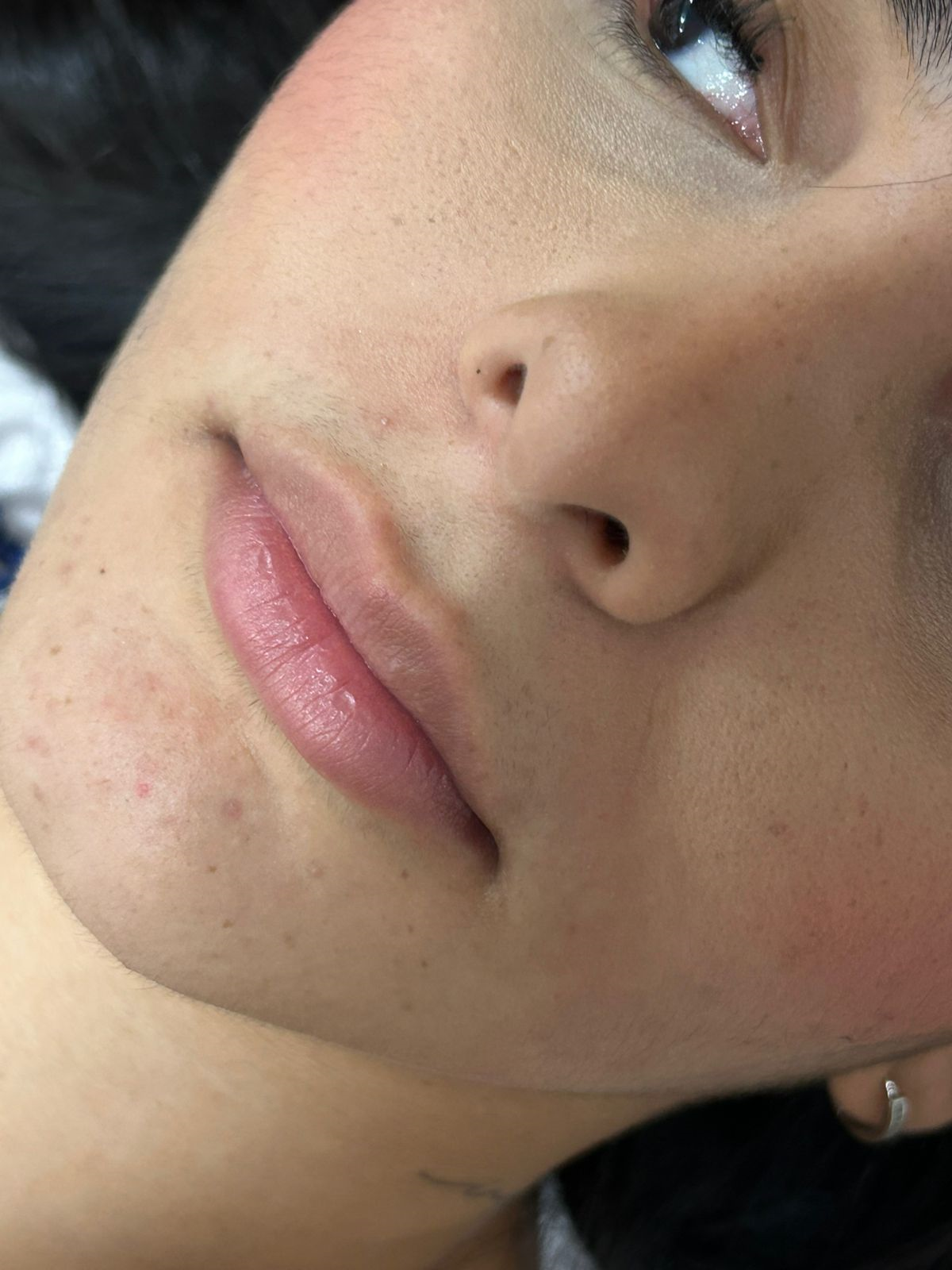 Resultado Antes - Preenchimento Labial