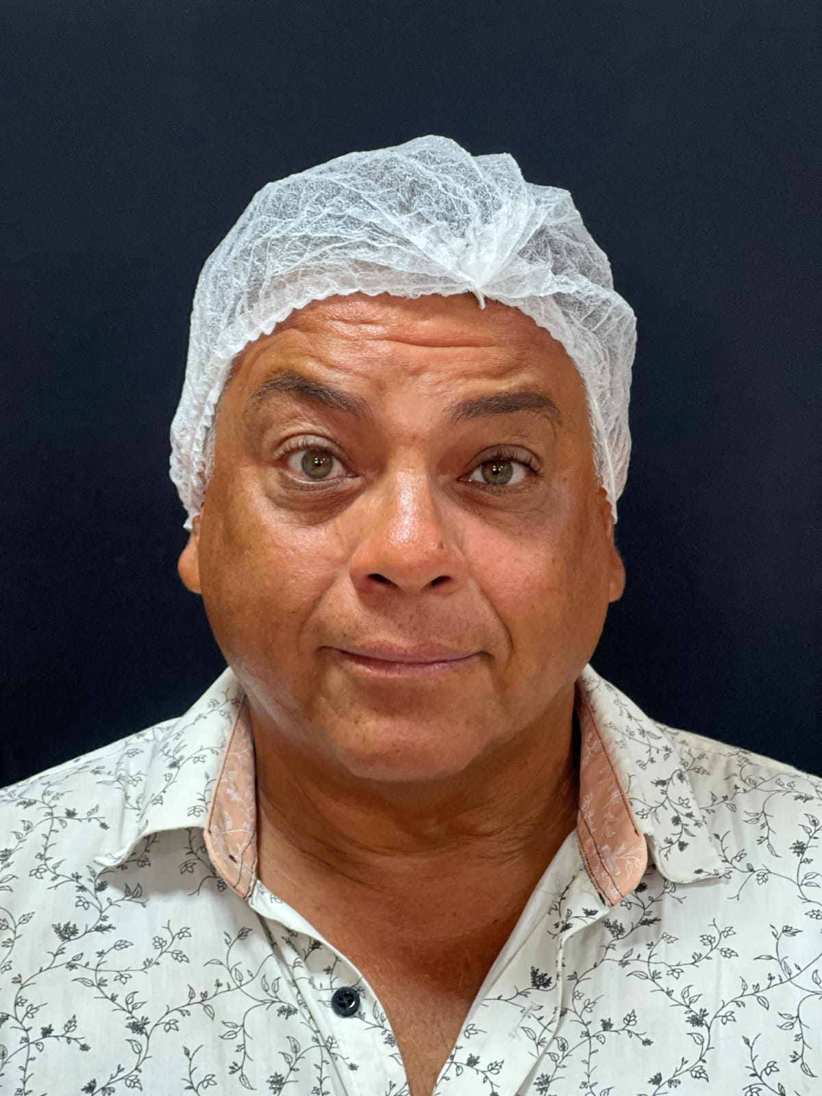 Resultado Antes - Aplicação de Botox